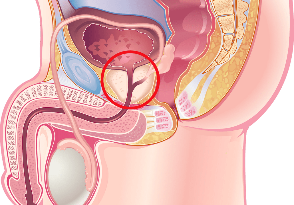 symptoms and signs of prostatitis