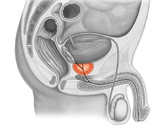 Vospalenie-of-prostate -