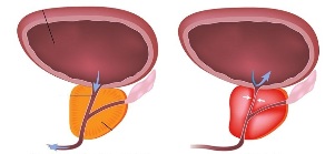 the prostate gland in men