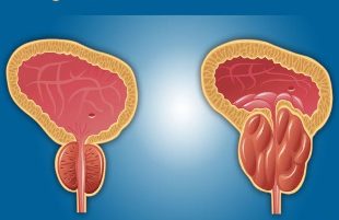 prostatitis picture