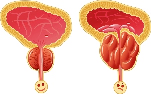 The prostate gland both normal and inflamed