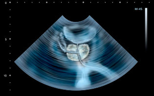 The symptoms of prostatitis ultrasound